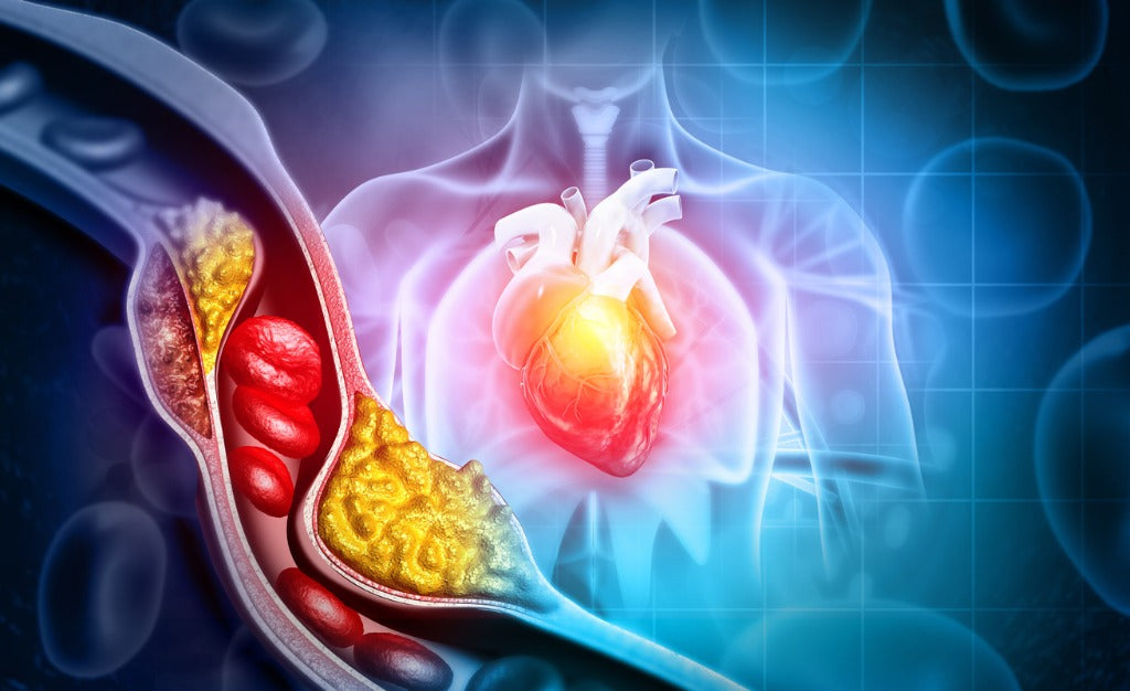 High Cholesterol- Are You at Risk?